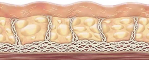 Ultherapy 1 Ultherapy 1