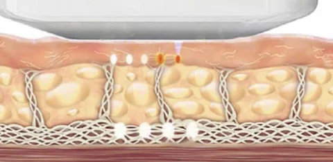 Ultherapy 2 Ultherapy 2