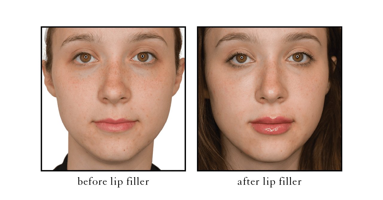 CSLC naples filler lip filler