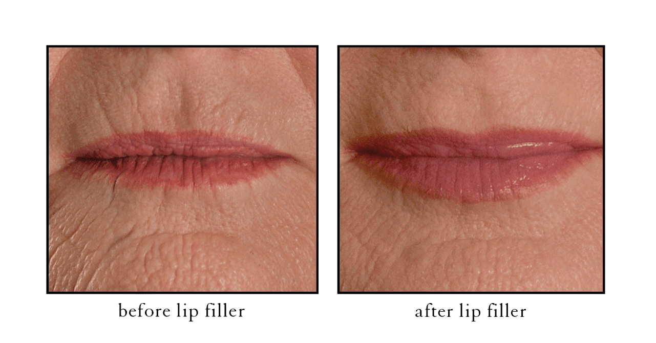 lip filler