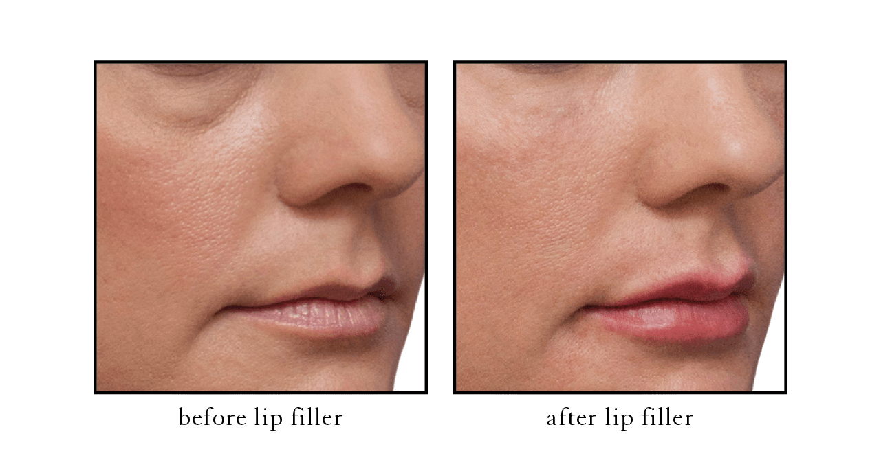 lip filler