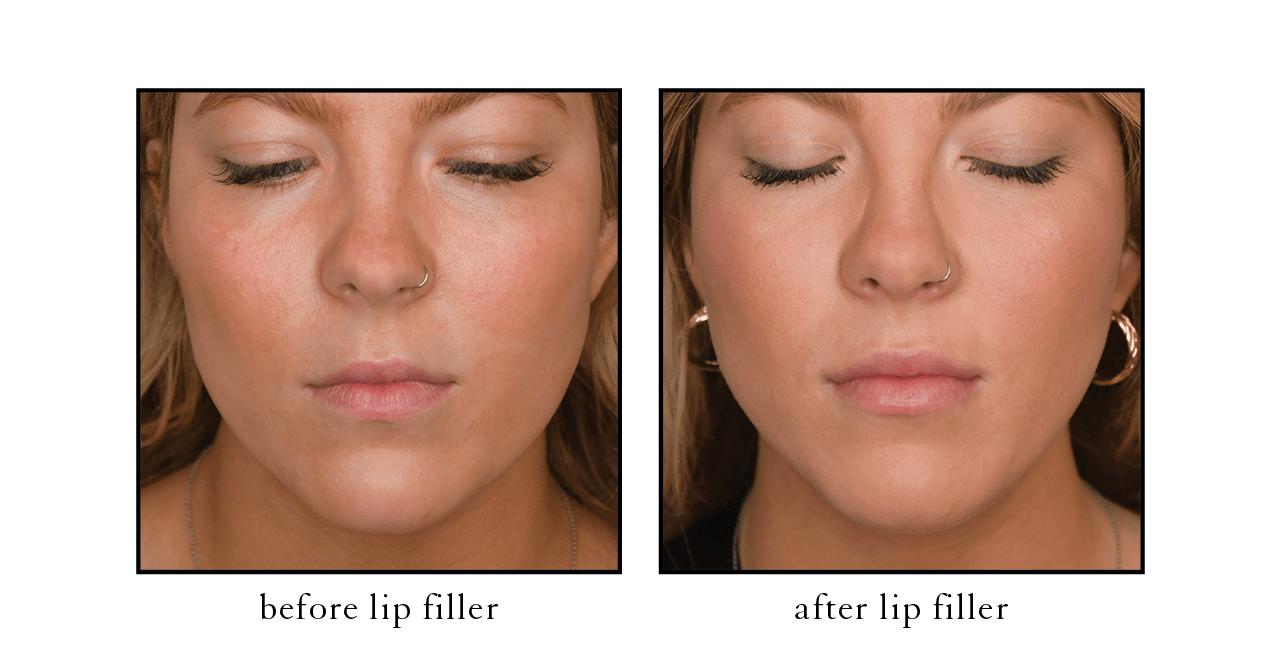 lip filler