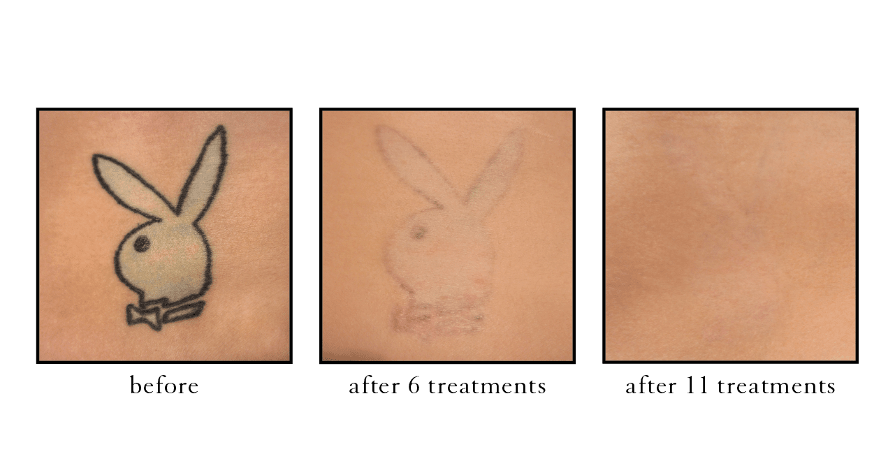 tattoo removal