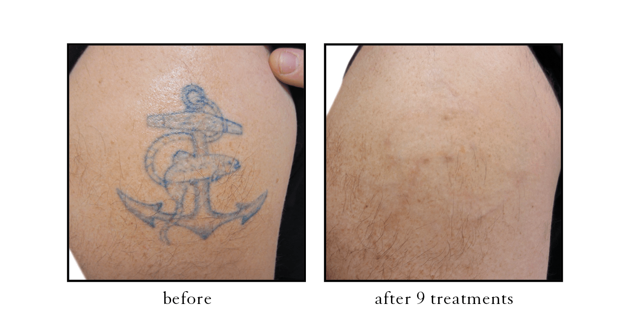 tattoo removal