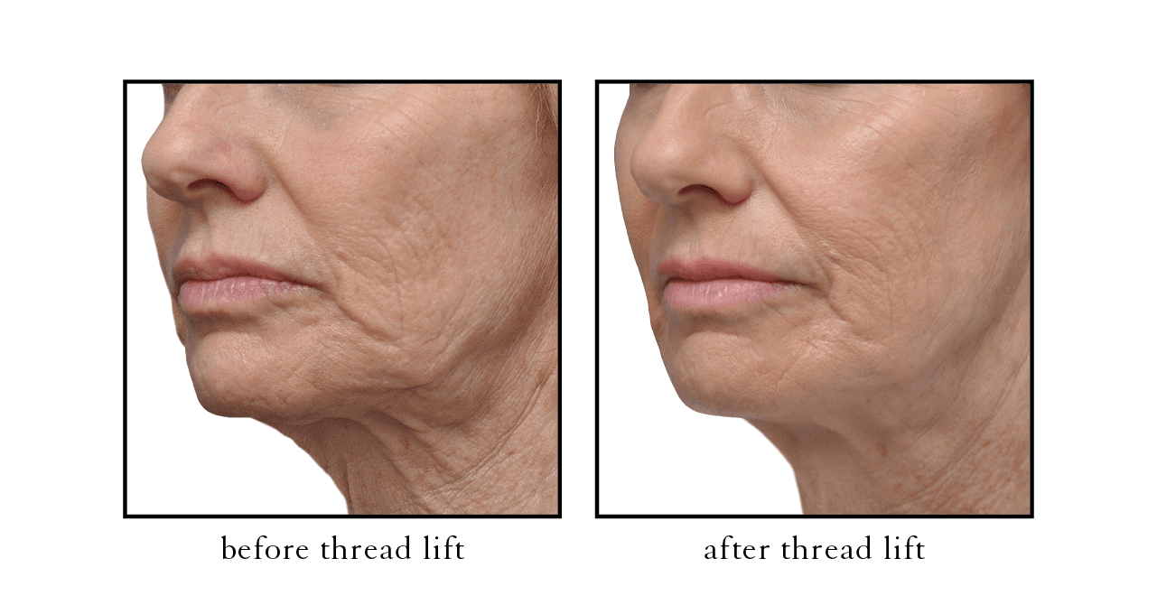 thread lift