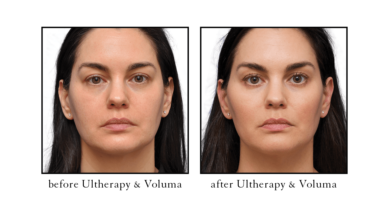 ultherapy