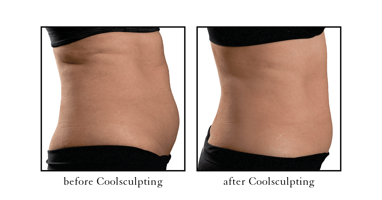 coolsculpting results