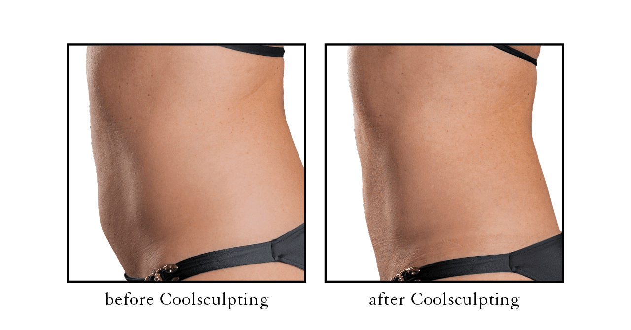 coolsculpting results