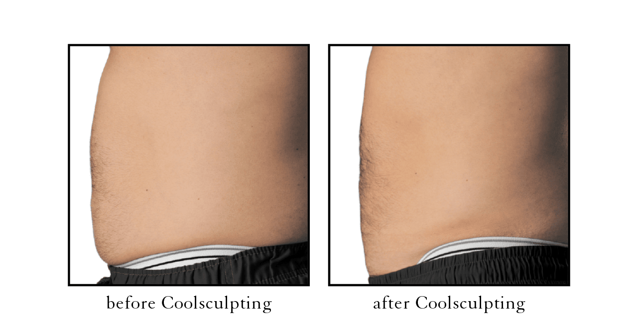 coolsculpting results