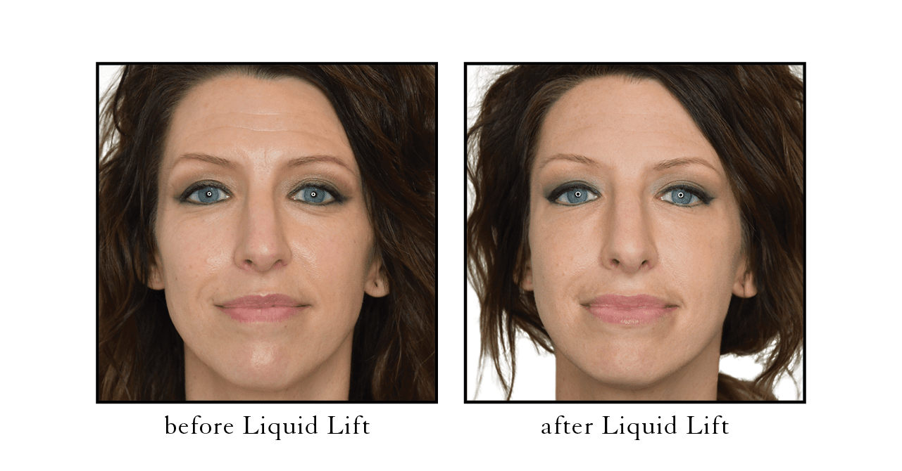 liquid lift before after