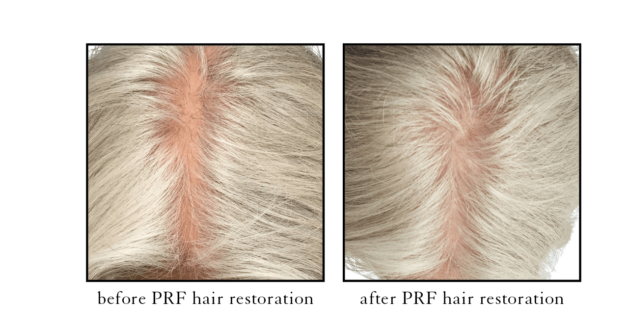 PRF hair restoration