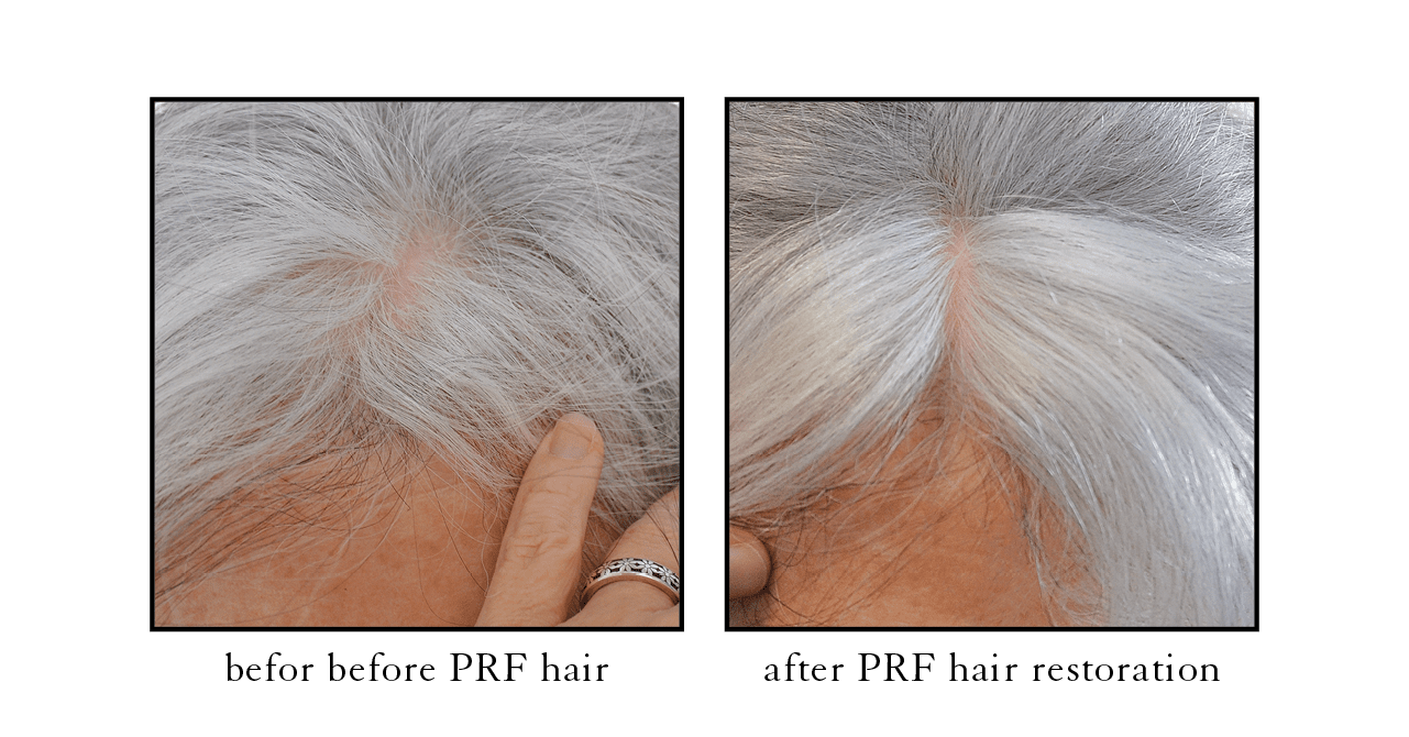 PRF hair restoration