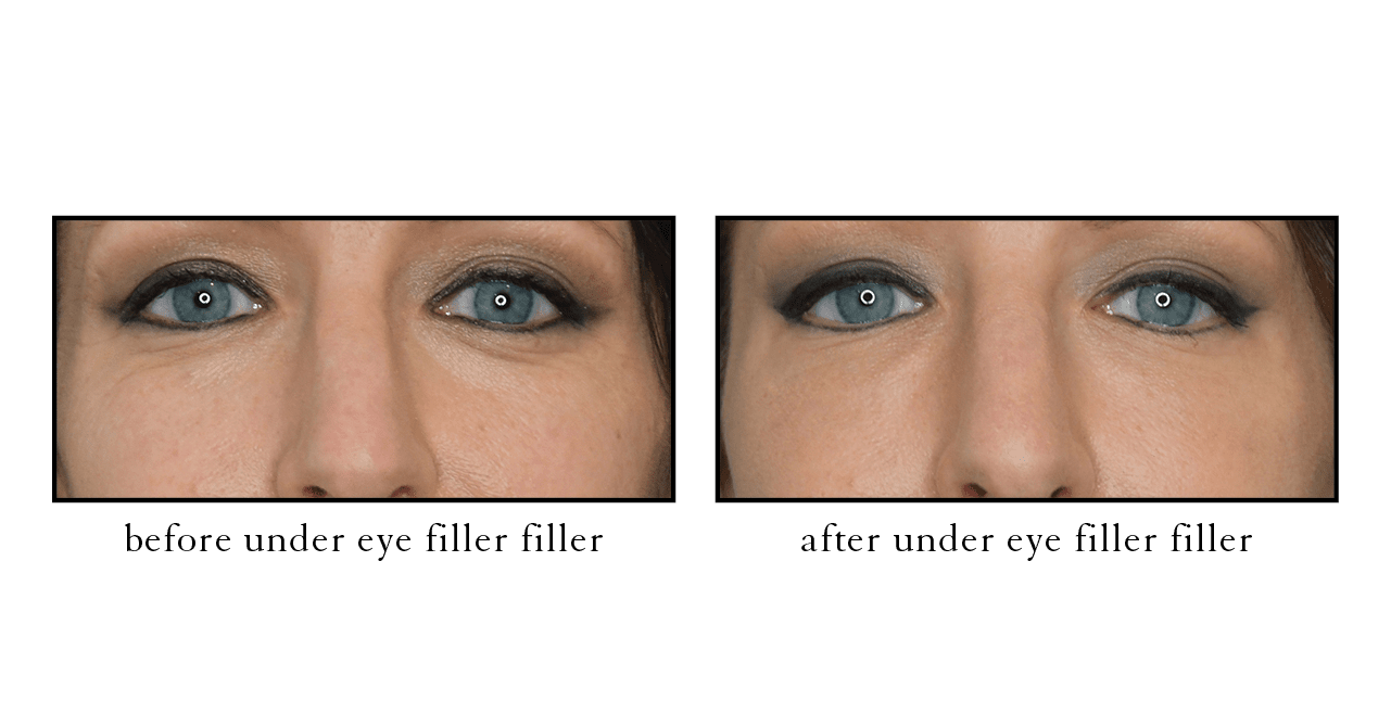 under eye filler