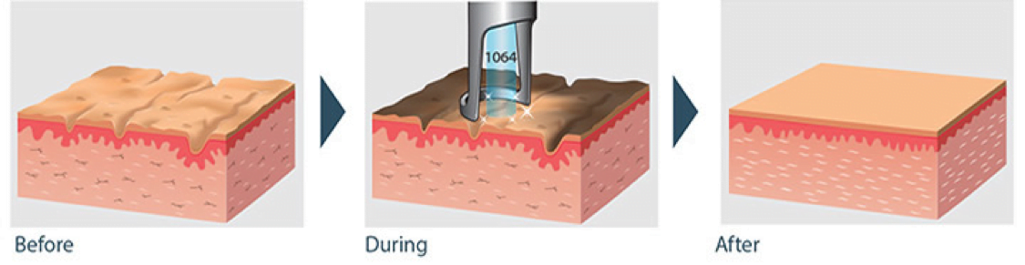 carbon laser peel