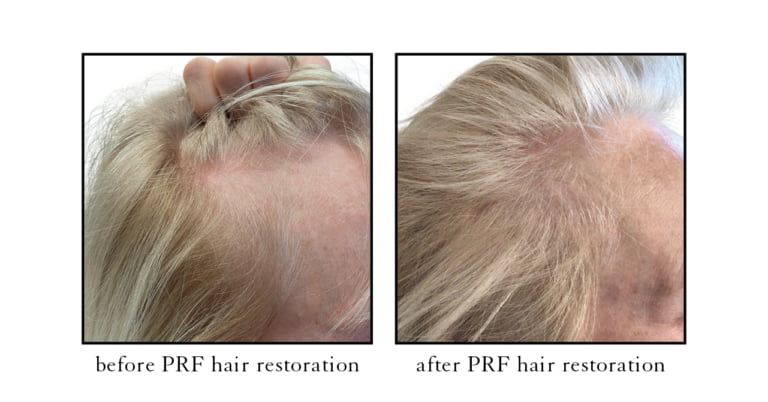 Before and after PRF hair restoration