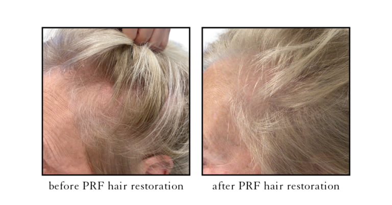 Before and after PRF hair restoration