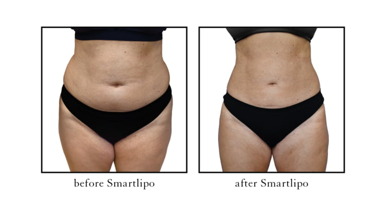 Before and after Smartlipo