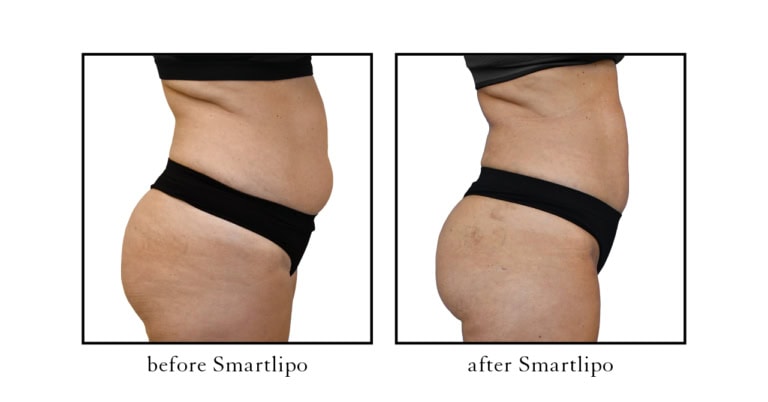 Before and after Smartlipo