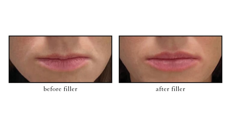 Before and after lip filler